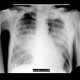 Pulmonary edema, first day: X-ray - Plain radiograph